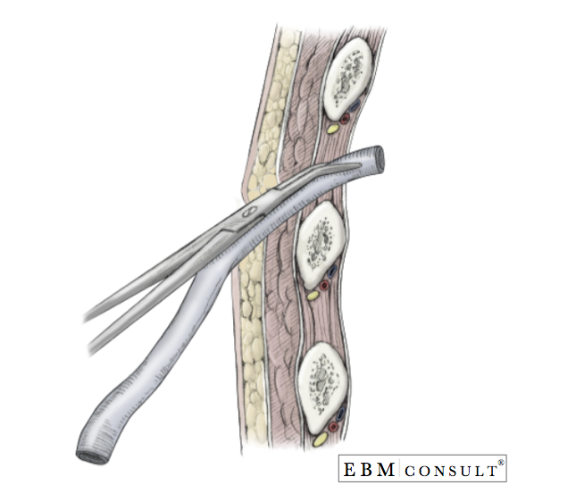 Chest Tube Placement Thoracostomy Procedure